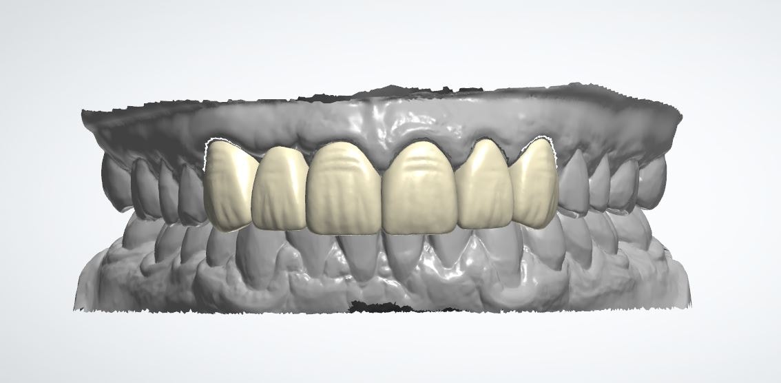 Dental crown and bridge CAD design