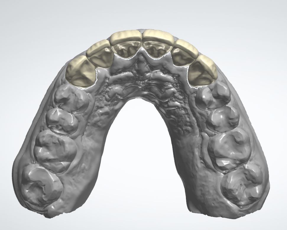 Dental arch crown bridge model