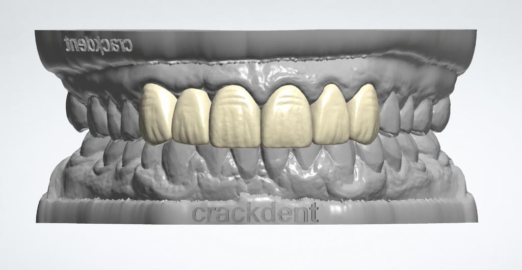 Dental crown bridge anterior CAD design
