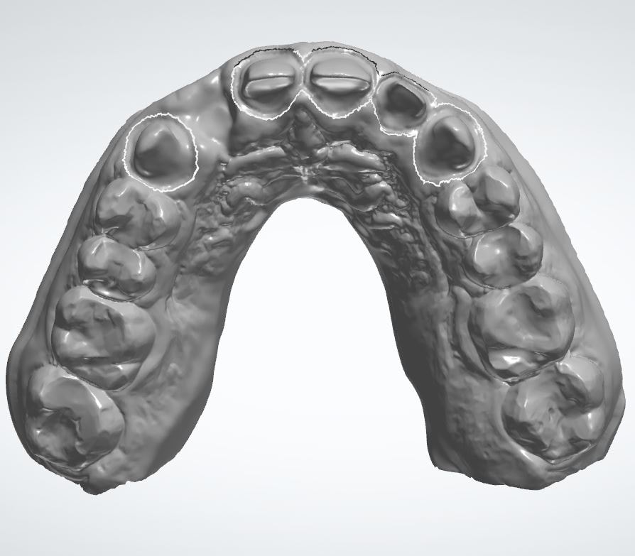 Dental crown bridge row CAD design