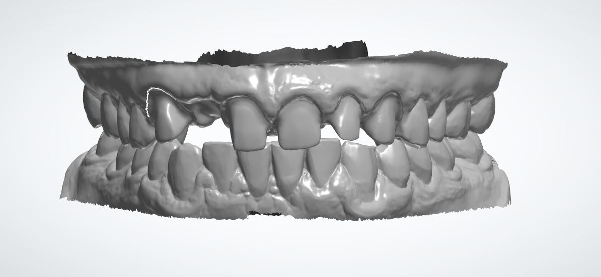 Dental crown bridge row CAD design